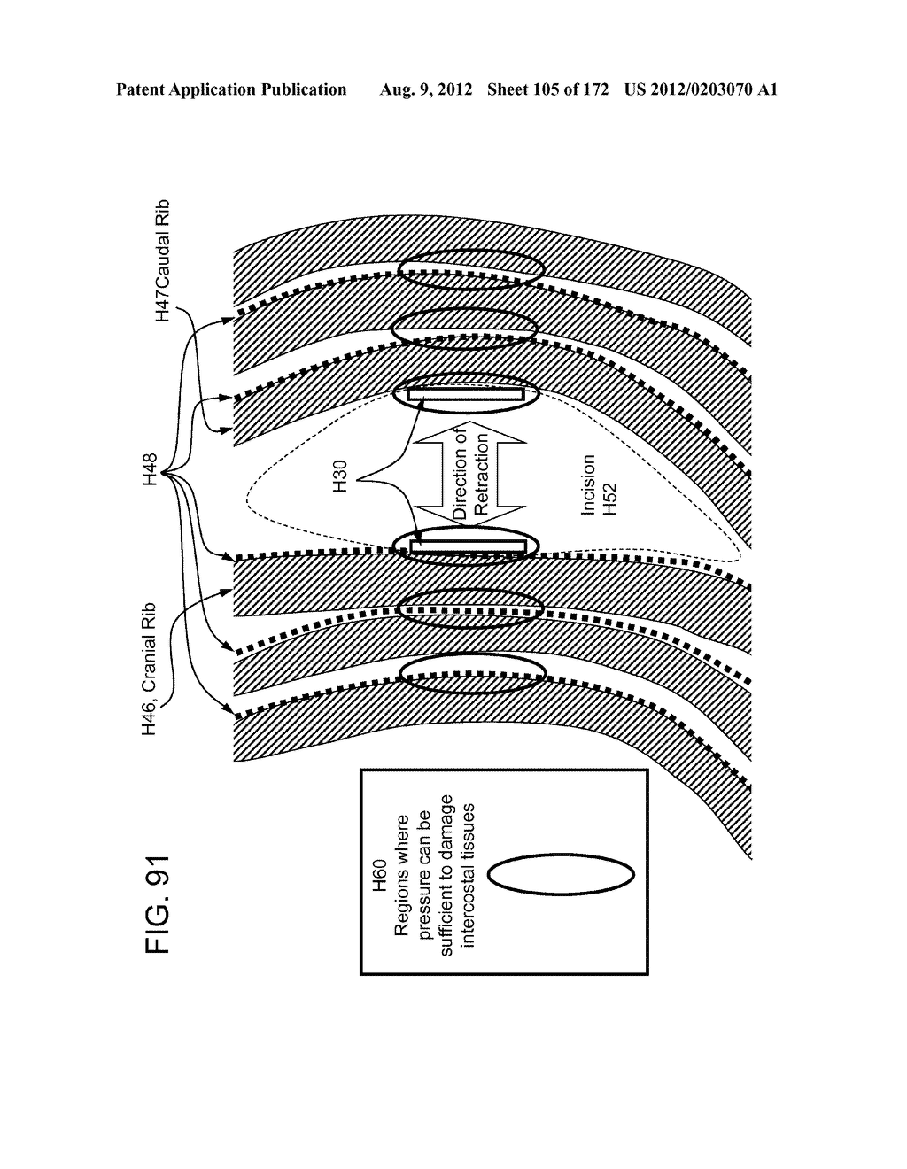 METHODS AND DEVICES TO DECREASE TISSUE TRAUMA DURING SURGERY - diagram, schematic, and image 106