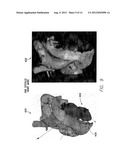 SYSTEMS AND METHODS FOR TRACKING STROKE VOLUME USING HYBRID IMPEDANCE     CONFIGURATIONS EMPLOYING A MULTI-POLE IMPLANTABLE CARDIAC LEAD diagram and image