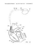 SYSTEMS AND METHODS FOR TRACKING STROKE VOLUME USING HYBRID IMPEDANCE     CONFIGURATIONS EMPLOYING A MULTI-POLE IMPLANTABLE CARDIAC LEAD diagram and image