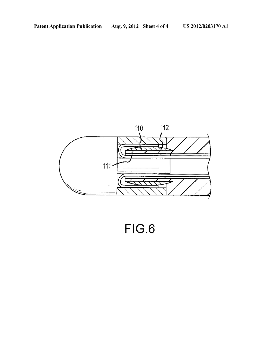 MEDICAL CATHETER ASSEMBLY WITH DEFLECTION PULL RING AND DISTAL TIP     INTERLOCK - diagram, schematic, and image 05