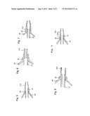 CATHETER HAVING A SOFT DISTAL TIP diagram and image