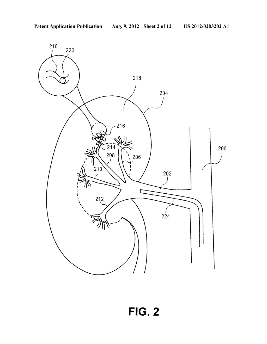 METHOD AND APPARATUS FOR DELIVERING AN AGENT TO A KIDNEY - diagram, schematic, and image 03