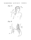 REDUCTION OF INFLAMMATORY MASS WITH SPINAL CATHETERS diagram and image