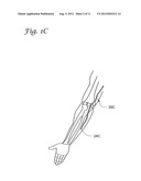 REDUCTION OF INFLAMMATORY MASS WITH SPINAL CATHETERS diagram and image