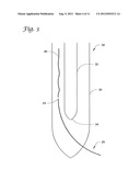 REDUCTION OF INFLAMMATORY MASS WITH SPINAL CATHETERS diagram and image