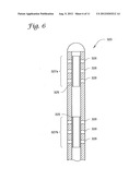 REDUCTION OF INFLAMMATORY MASS WITH SPINAL CATHETERS diagram and image