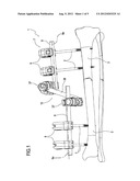 MULTI-PURPOSE EXTERNAL FIXATOR diagram and image