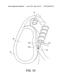 CURVED BUR diagram and image