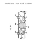 FEMORAL PROSTHETIC IMPLANT diagram and image