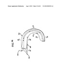 FEMORAL PROSTHETIC IMPLANT diagram and image