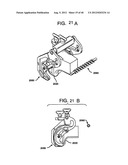 FEMORAL PROSTHETIC IMPLANT diagram and image