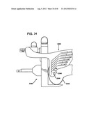 FEMORAL PROSTHETIC IMPLANT diagram and image