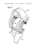 FEMORAL PROSTHETIC IMPLANT diagram and image