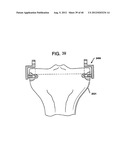 FEMORAL PROSTHETIC IMPLANT diagram and image