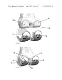 Device and Method for Bone Cement Removal diagram and image