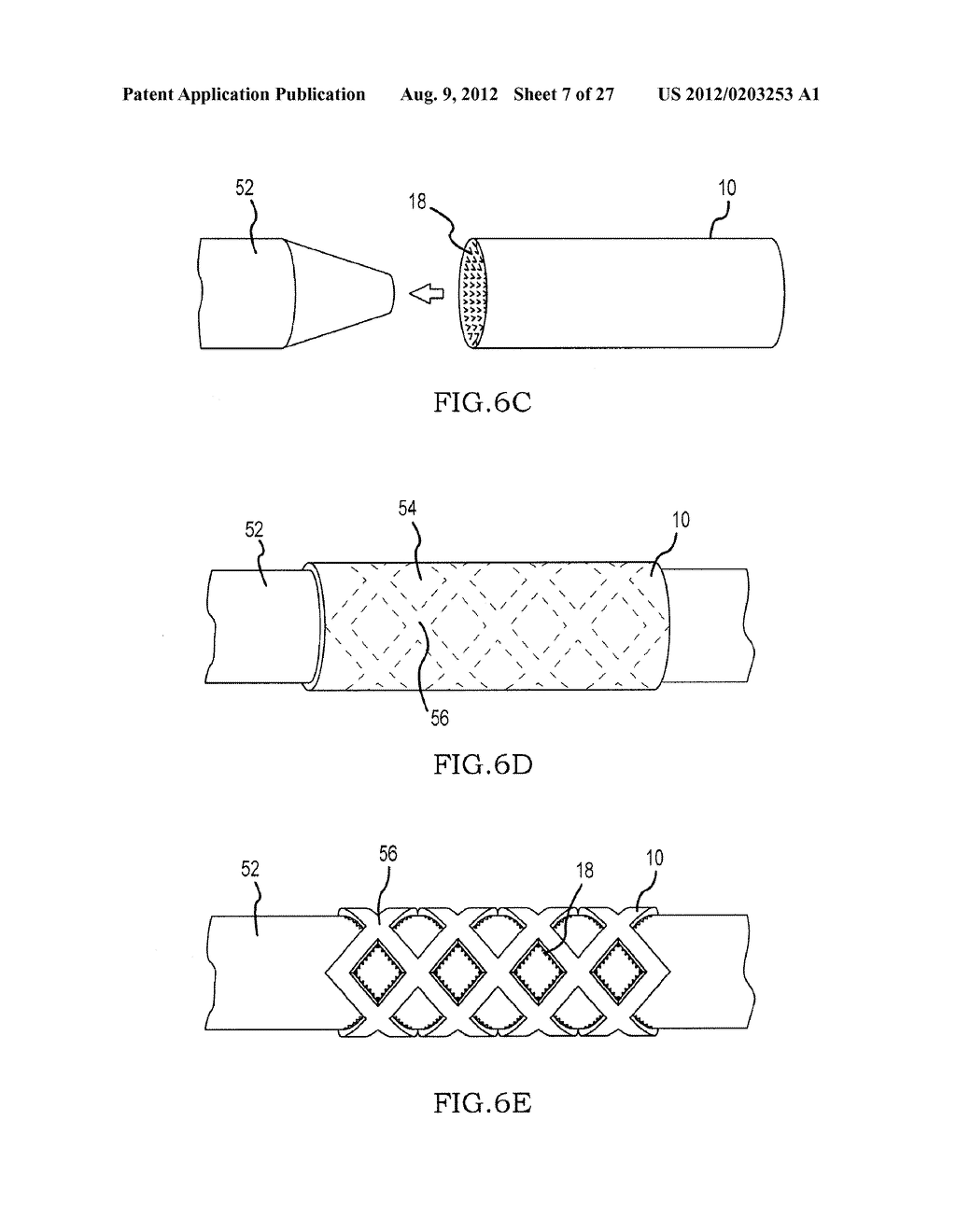 SYSTEM FOR TISSUE FIXATION TO BONE - diagram, schematic, and image 08