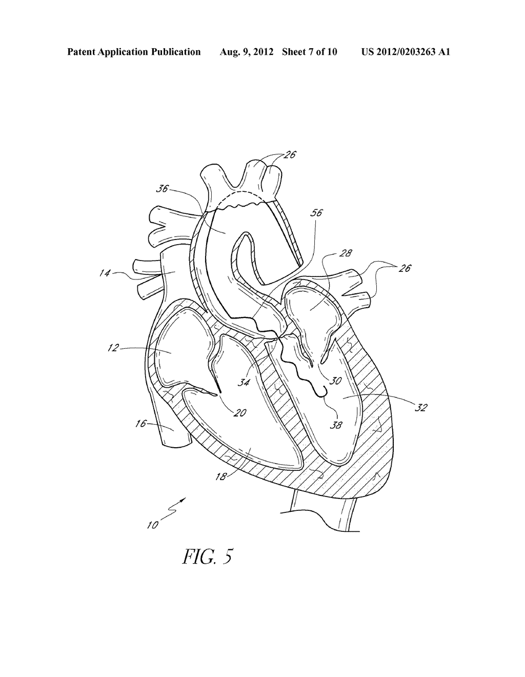 CATHETER GUIDANCE THROUGH A CALCIFIED AORTIC VALVE - diagram, schematic, and image 08