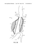 Graft Systems Having Semi-Permeable Filling Structures and Methods for     Their Use diagram and image