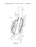 Graft Systems Having Semi-Permeable Filling Structures and Methods for     Their Use diagram and image