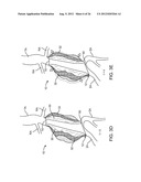 Graft Systems Having Semi-Permeable Filling Structures and Methods for     Their Use diagram and image