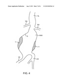 Graft Systems Having Semi-Permeable Filling Structures and Methods for     Their Use diagram and image