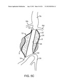 Graft Systems Having Semi-Permeable Filling Structures and Methods for     Their Use diagram and image