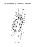 Graft Systems Having Semi-Permeable Filling Structures and Methods for     Their Use diagram and image