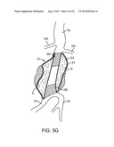 Graft Systems Having Semi-Permeable Filling Structures and Methods for     Their Use diagram and image