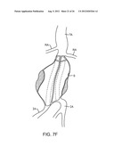 Graft Systems Having Semi-Permeable Filling Structures and Methods for     Their Use diagram and image