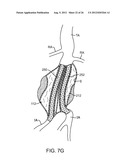 Graft Systems Having Semi-Permeable Filling Structures and Methods for     Their Use diagram and image