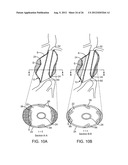 Graft Systems Having Semi-Permeable Filling Structures and Methods for     Their Use diagram and image