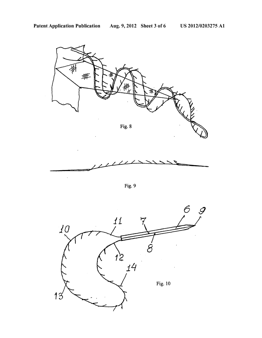 SURGICAL SUTURE MATERIAL AND METHOD FOR THE APPLICATION THEREOF - diagram, schematic, and image 04