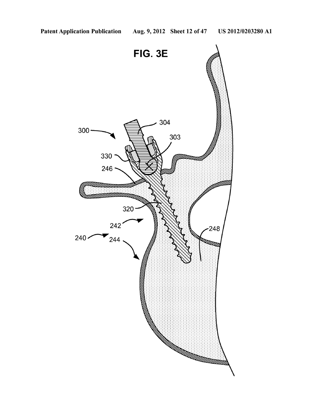 LOW PROFILE SPINAL PROSTHESIS INCORPORATING A CANNULATED BONE ANCHOR     HAVING A DEFLECTABLE POST AND A COMPOUND SPINAL ROD - diagram, schematic, and image 13