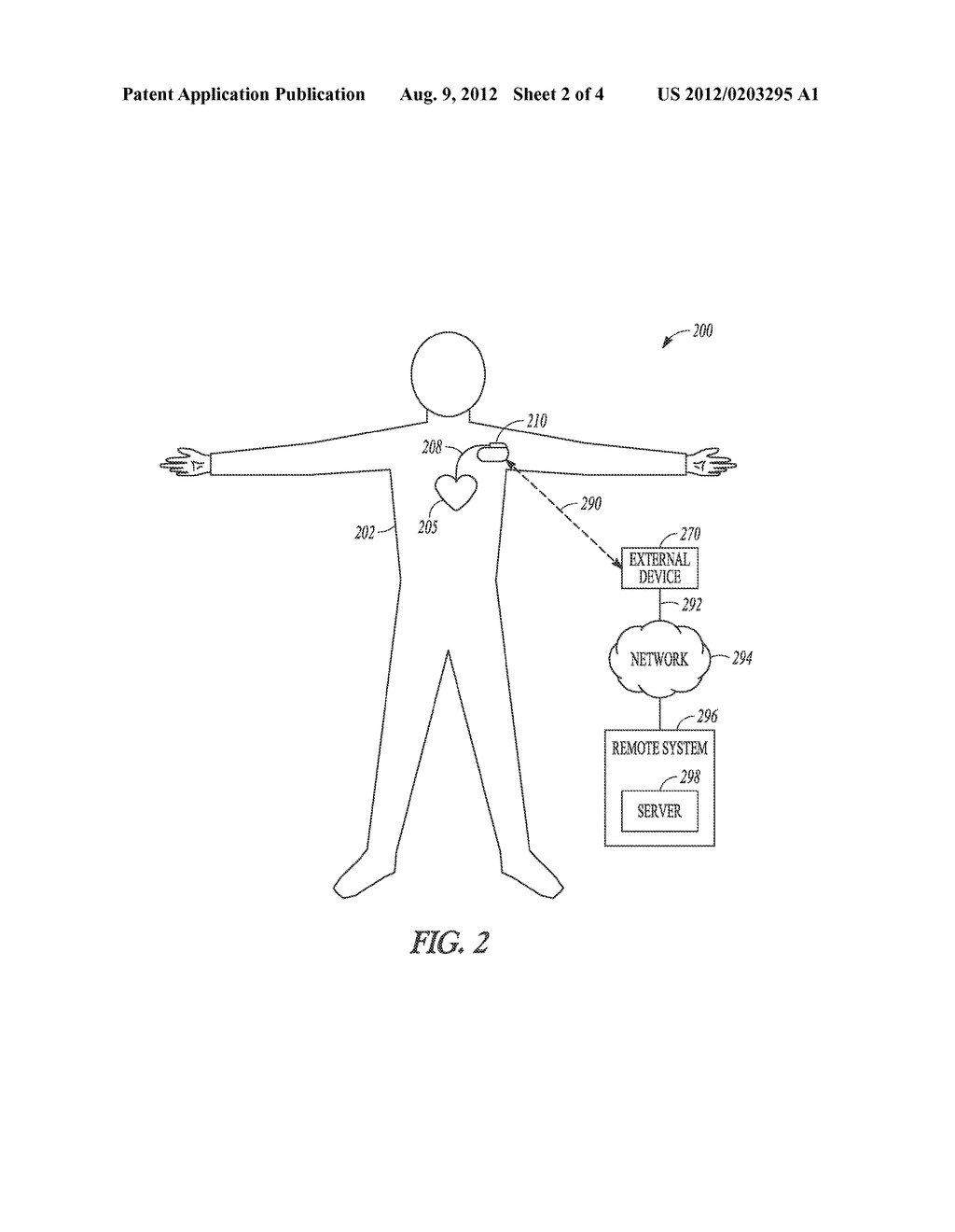 PACING SITE OPTIMIZATION USING PACED INTERVENTRICULAR DELAYS - diagram, schematic, and image 03