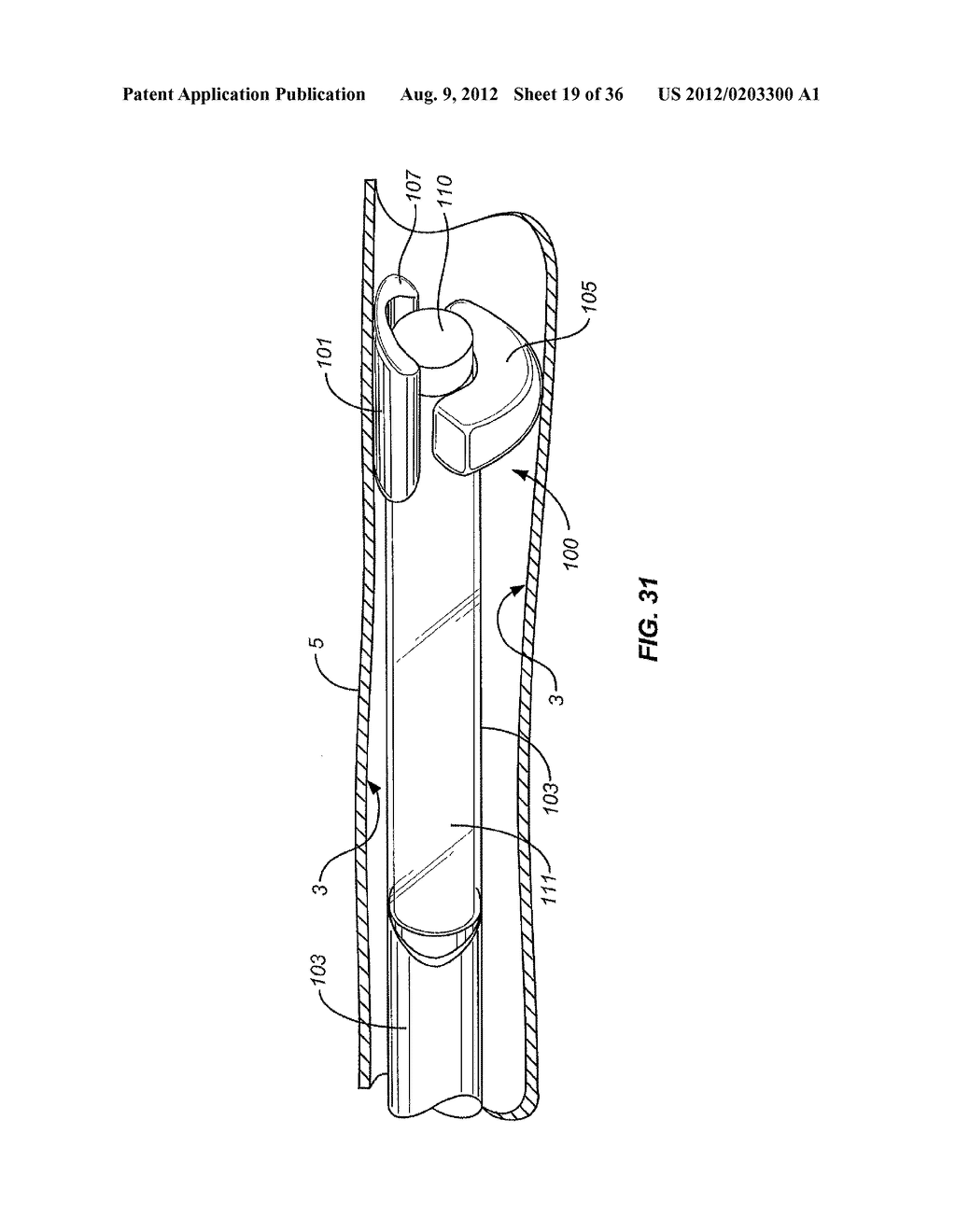 Method and Apparatus for Ablation of Benign, Pre-Cancerous and Early     Cancerous Lesions That Originate Within the Epithelium and are Limited to     the Mucosal Layer of the Gastrointestinal Tract - diagram, schematic, and image 20