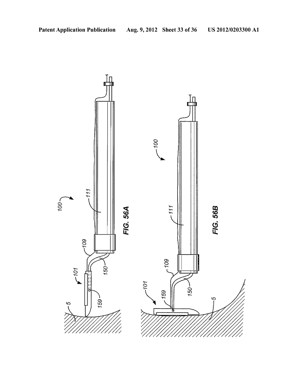 Method and Apparatus for Ablation of Benign, Pre-Cancerous and Early     Cancerous Lesions That Originate Within the Epithelium and are Limited to     the Mucosal Layer of the Gastrointestinal Tract - diagram, schematic, and image 34