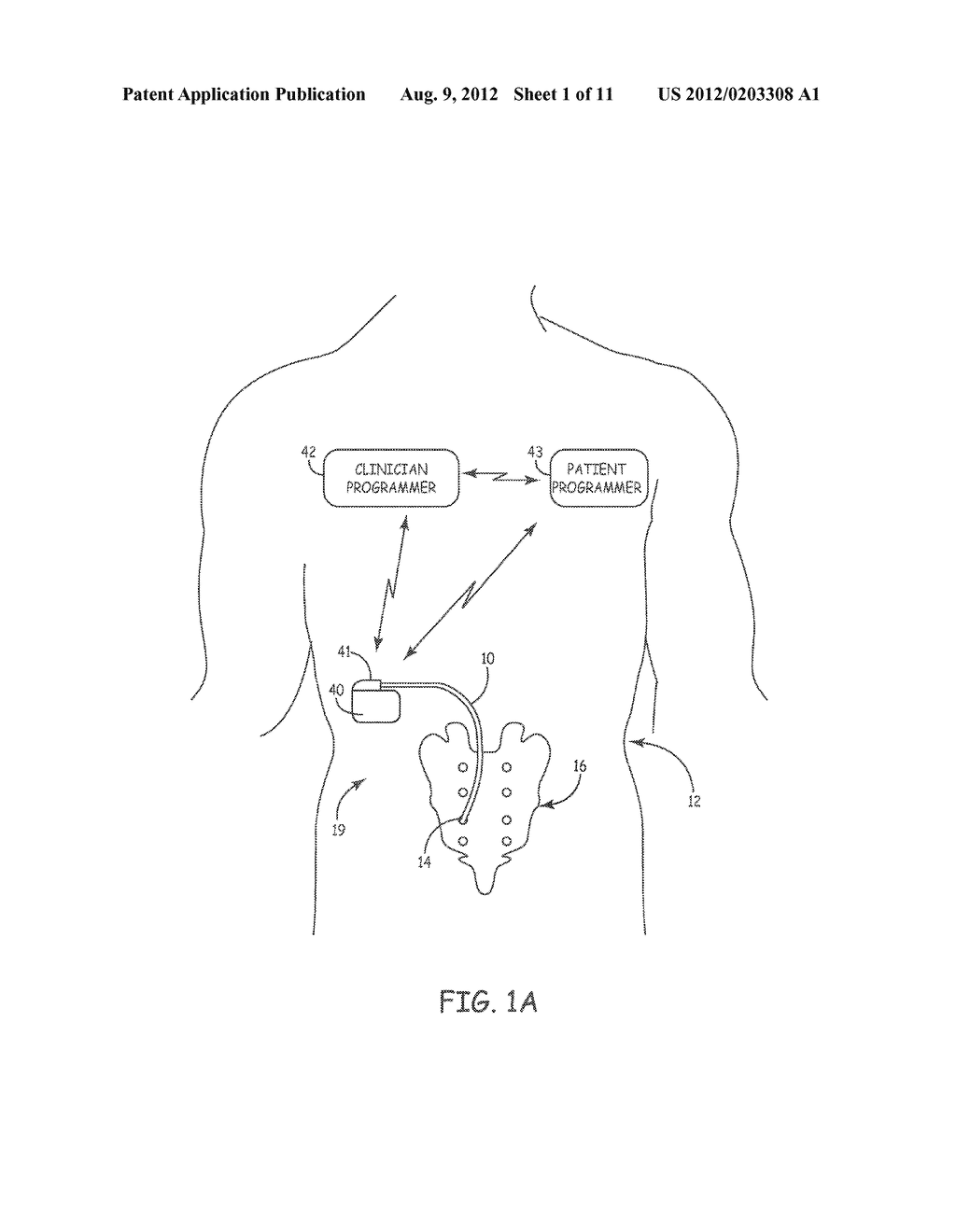 IMPLANTABLE MEDICAL ELECTRICAL STIMULATION LEAD FIXATION METHOD AND     APPARATUS - diagram, schematic, and image 02