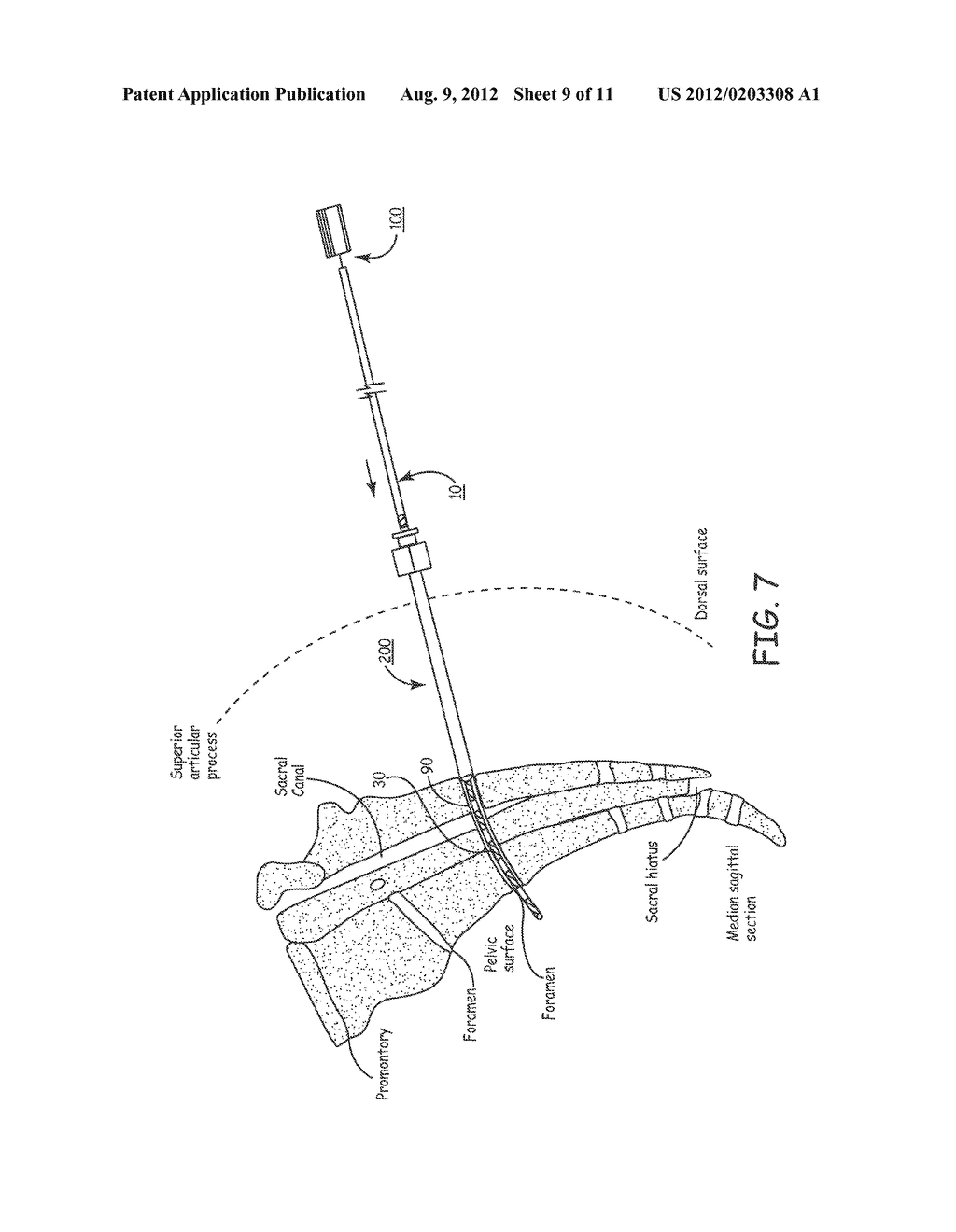 IMPLANTABLE MEDICAL ELECTRICAL STIMULATION LEAD FIXATION METHOD AND     APPARATUS - diagram, schematic, and image 10