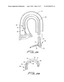 PERCUTANEOUS AORTIC VALVE diagram and image