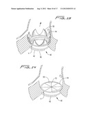 PERCUTANEOUS AORTIC VALVE diagram and image