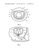 DEVICE AND METHOD FOR TEMPORARY OR PERMANENT SUSPENSION OF AN IMPLANTABLE     SCAFFOLDING CONTAINING AN ORIFICE FOR PLACEMENT OF A PROSTHETIC OR     BIO-PROSTHETIC VALVE diagram and image