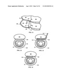 DEVICE AND METHOD FOR TEMPORARY OR PERMANENT SUSPENSION OF AN IMPLANTABLE     SCAFFOLDING CONTAINING AN ORIFICE FOR PLACEMENT OF A PROSTHETIC OR     BIO-PROSTHETIC VALVE diagram and image