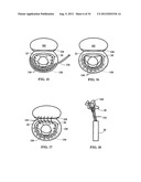 DEVICE AND METHOD FOR TEMPORARY OR PERMANENT SUSPENSION OF AN IMPLANTABLE     SCAFFOLDING CONTAINING AN ORIFICE FOR PLACEMENT OF A PROSTHETIC OR     BIO-PROSTHETIC VALVE diagram and image