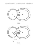 DEVICE AND METHOD FOR TEMPORARY OR PERMANENT SUSPENSION OF AN IMPLANTABLE     SCAFFOLDING CONTAINING AN ORIFICE FOR PLACEMENT OF A PROSTHETIC OR     BIO-PROSTHETIC VALVE diagram and image