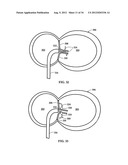 DEVICE AND METHOD FOR TEMPORARY OR PERMANENT SUSPENSION OF AN IMPLANTABLE     SCAFFOLDING CONTAINING AN ORIFICE FOR PLACEMENT OF A PROSTHETIC OR     BIO-PROSTHETIC VALVE diagram and image