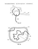 DEVICE AND METHOD FOR TEMPORARY OR PERMANENT SUSPENSION OF AN IMPLANTABLE     SCAFFOLDING CONTAINING AN ORIFICE FOR PLACEMENT OF A PROSTHETIC OR     BIO-PROSTHETIC VALVE diagram and image