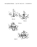 DEVICE AND METHOD FOR TEMPORARY OR PERMANENT SUSPENSION OF AN IMPLANTABLE     SCAFFOLDING CONTAINING AN ORIFICE FOR PLACEMENT OF A PROSTHETIC OR     BIO-PROSTHETIC VALVE diagram and image