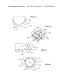 DEVICE AND METHOD FOR TEMPORARY OR PERMANENT SUSPENSION OF AN IMPLANTABLE     SCAFFOLDING CONTAINING AN ORIFICE FOR PLACEMENT OF A PROSTHETIC OR     BIO-PROSTHETIC VALVE diagram and image