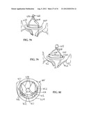 DEVICE AND METHOD FOR TEMPORARY OR PERMANENT SUSPENSION OF AN IMPLANTABLE     SCAFFOLDING CONTAINING AN ORIFICE FOR PLACEMENT OF A PROSTHETIC OR     BIO-PROSTHETIC VALVE diagram and image