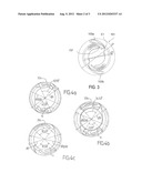 INTRAOCULAR IMPLANT diagram and image